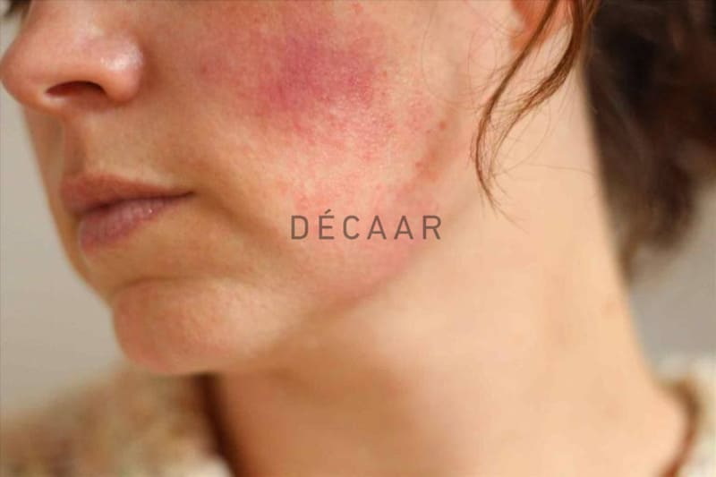 Da bị nhiễm Corticoid cần detox